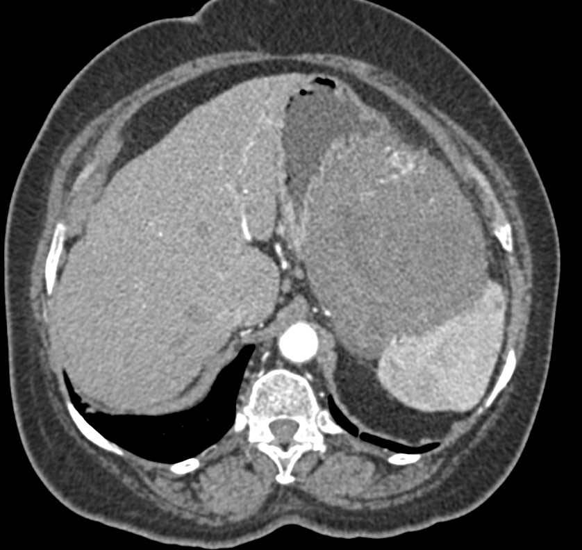 Exophytic Gastric GIST Tumor - Stomach Case Studies - CTisus CT Scanning