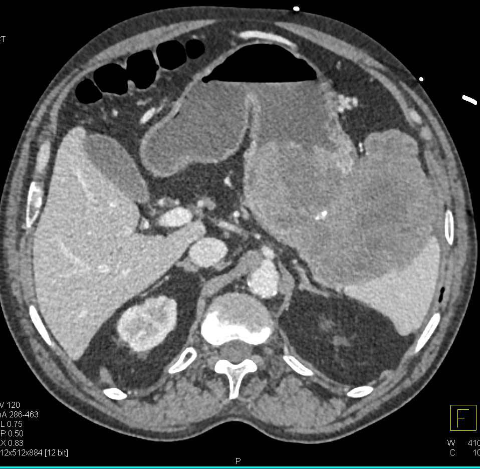 Gastric GIST Tumor - Stomach Case Studies - CTisus CT Scanning