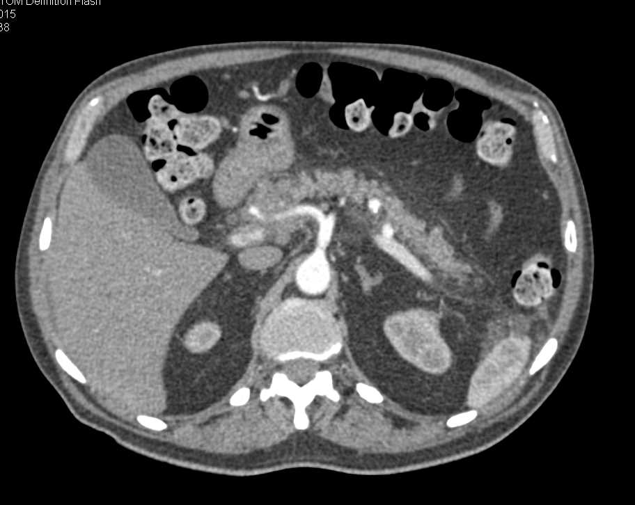 Bulky Gastric Adenocarcinoma with Bulky Adenopathy - CTisus CT Scan