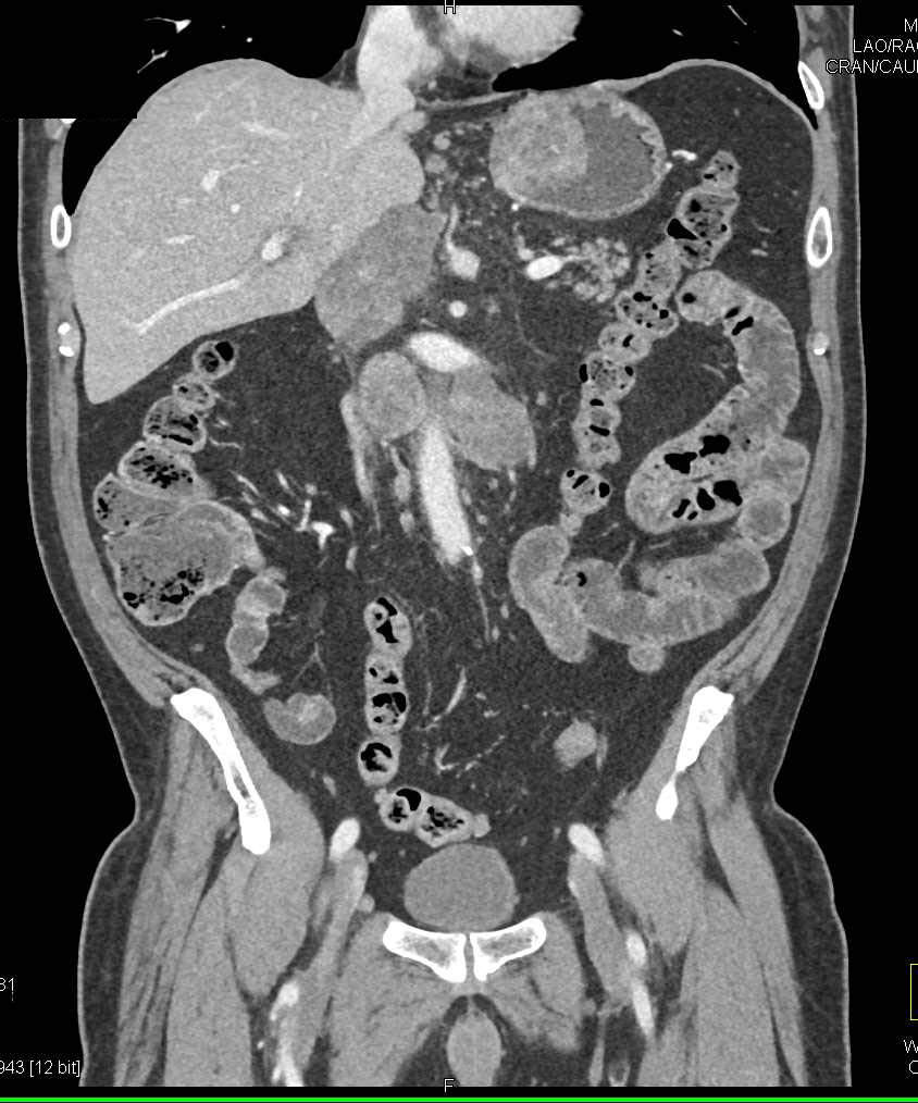 Gastric Cancer With Extensive Adenopathy Near Portocaval Space