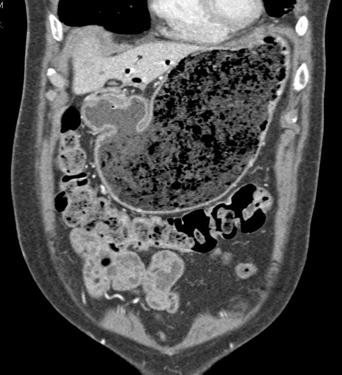 Gastric Cancer with Gastric Outlet Obstruction - CTisus CT Scan