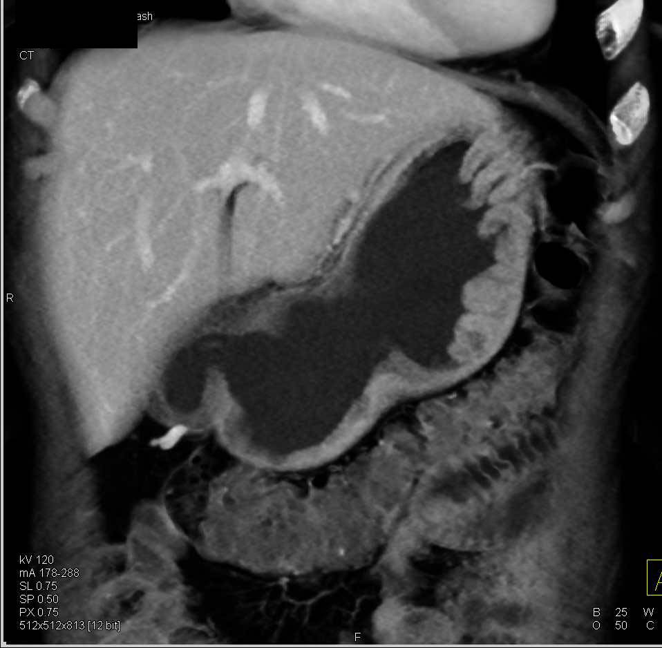 Thickened Stomach Folds in Zollinger-Ellison Syndrome - CTisus CT Scan