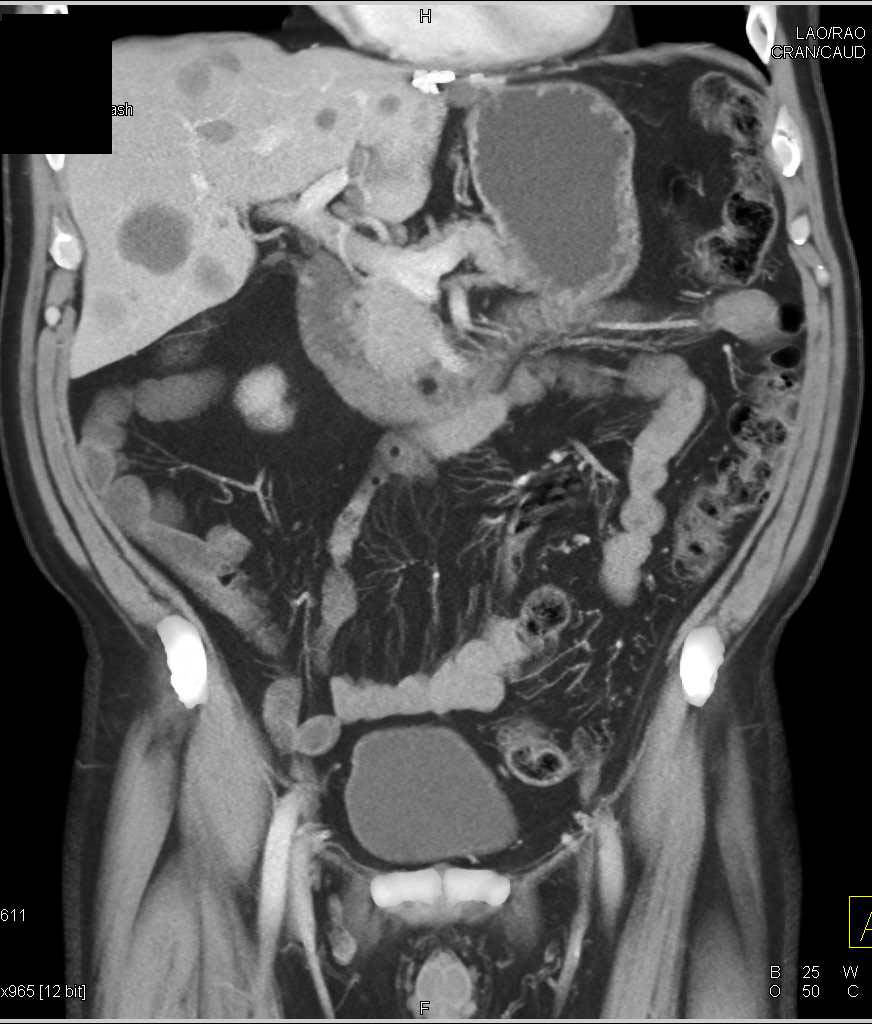 Incidental Duodenal Lipoma - CTisus CT Scan