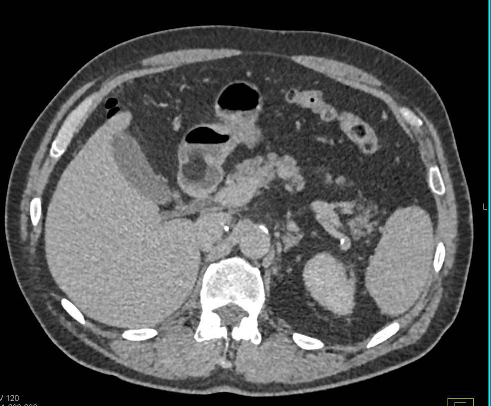 Gastric Lipoma - CTisus CT Scan