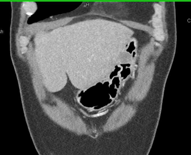 Gastric GIST Tumor - CTisus CT Scan