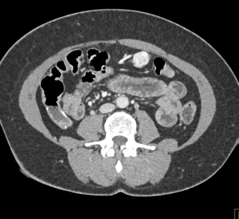 Infiltrating Gastric Cancer and Enhancing Nodes - CTisus CT Scan