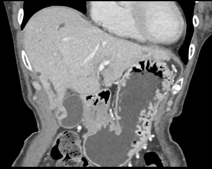 Antral Carcinoma of the Stomach - CTisus CT Scan