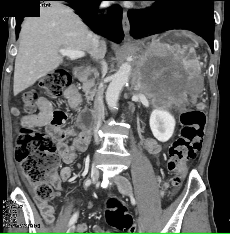 Gastric GIST Tumor with Extensive Tumor Spread - CTisus CT Scan