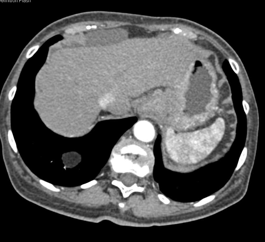 Gastric Adenocarcinoma with Distant Metastases - CTisus CT Scan