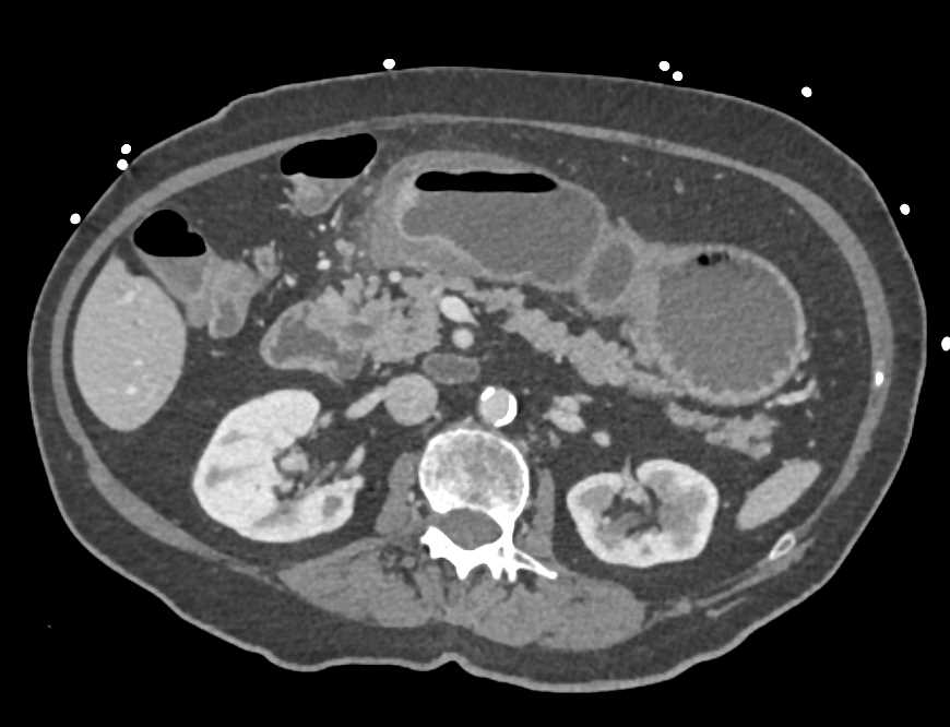 Carcinoma of the Gastric Antrum - CTisus CT Scan