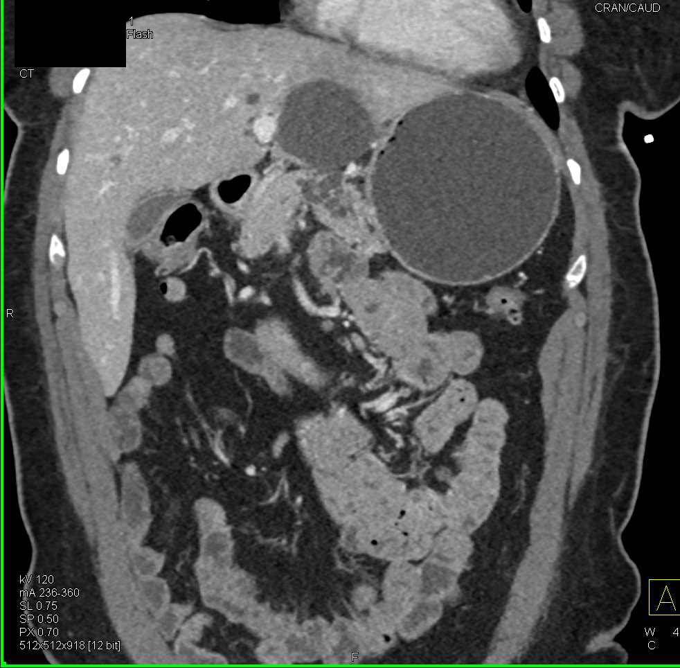 1 cm Gastric GIST Tumor - CTisus CT Scan