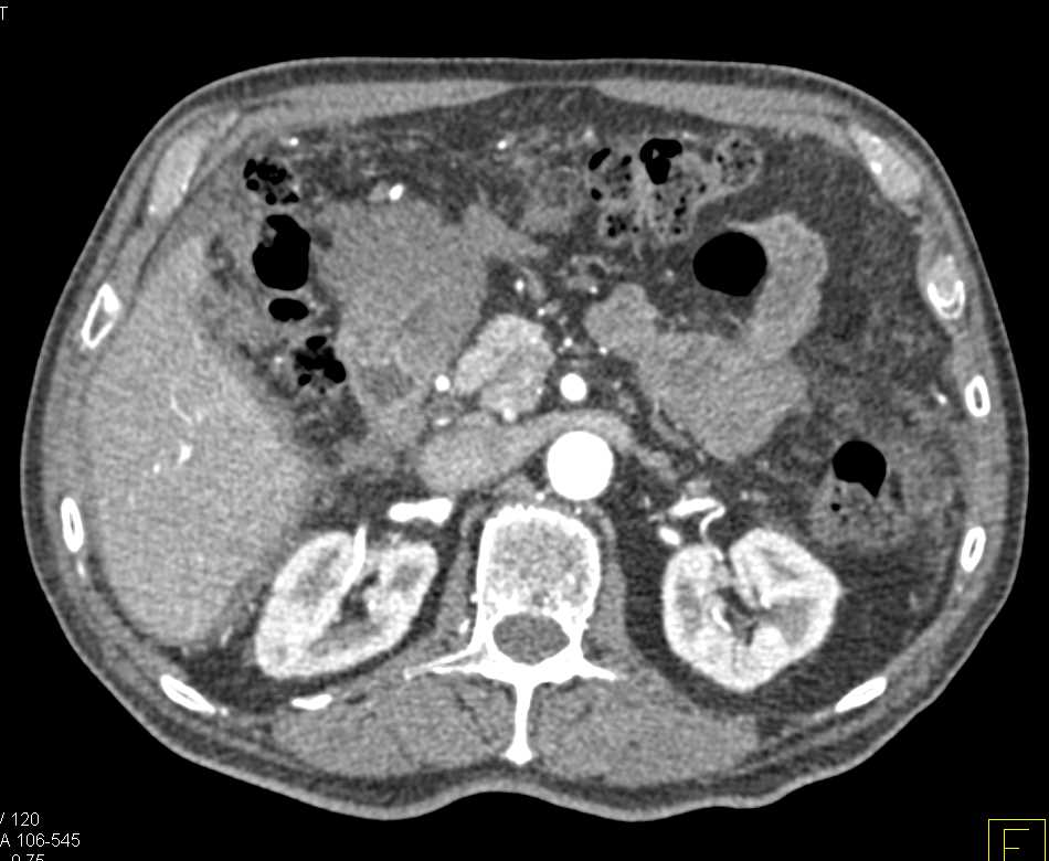 Infiltration of the Gastric Antrum with Carcinomatosis - CTisus CT Scan