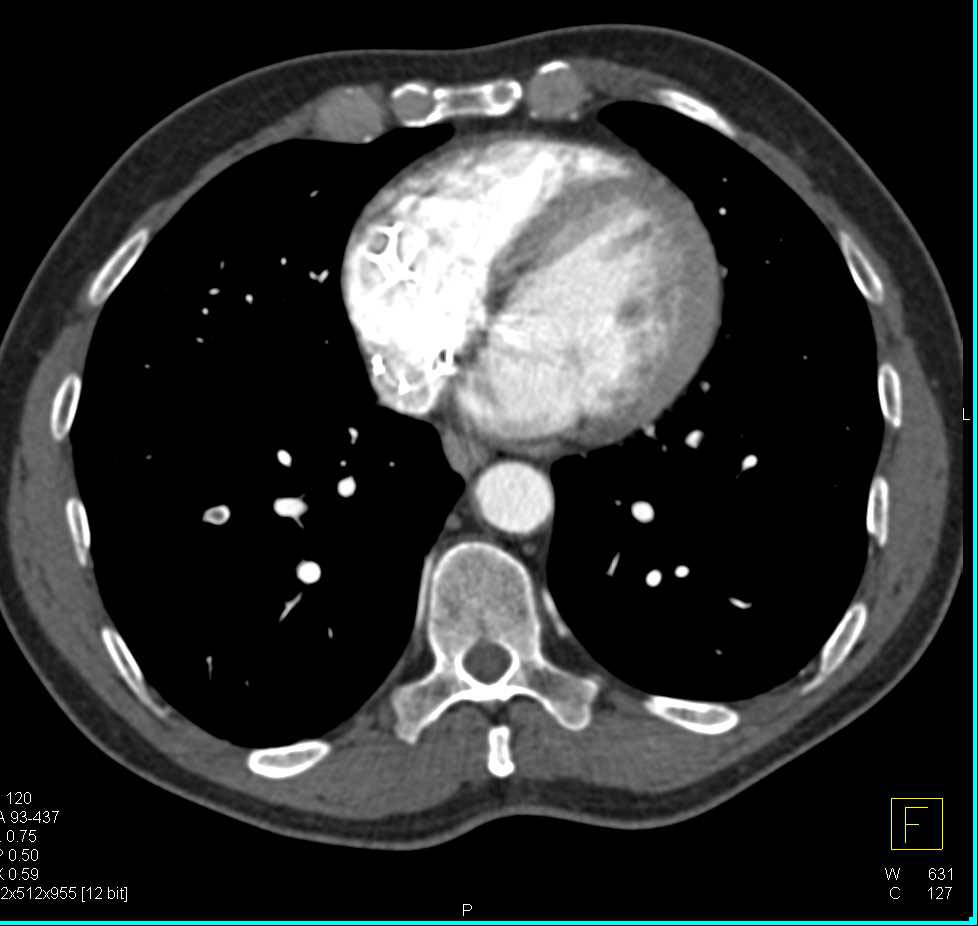 Emphysematous Gastritis with Air in Hepatic Veins and Pulmonary Embolism (PE) - CTisus CT Scan