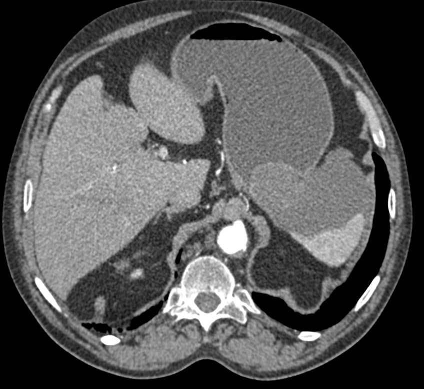 Gastric GIST Tumor - CTisus CT Scan