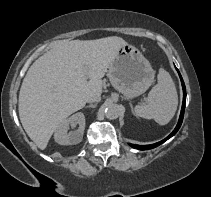 Polypoid Gastric Mass was an Adenocarcinoma. Prior Right kidney Noted - CTisus CT Scan