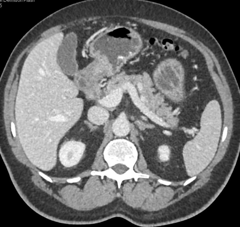 Neuroendocrine Tumor of the Pancreas with Gastric Fold Thickening and Zollinger-Ellison Syndrome - CTisus CT Scan