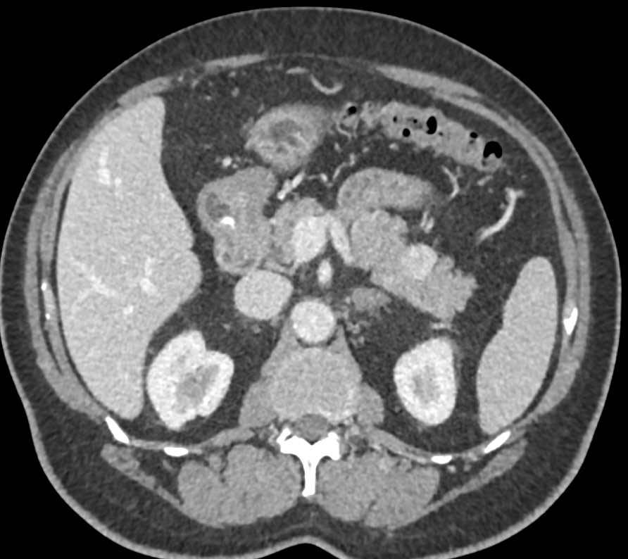 Neuroendocrine Tumor of the Pancreas with Gastric Fold Thickening and Zollinger-Ellison Syndrome - CTisus CT Scan