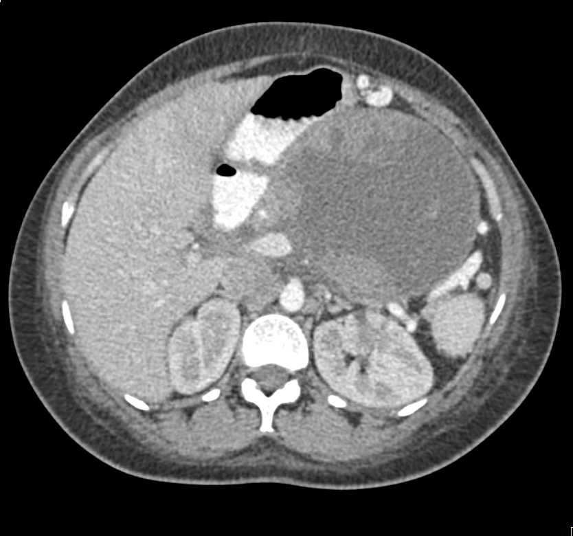 Gastric GIST Tumor - CTisus CT Scan