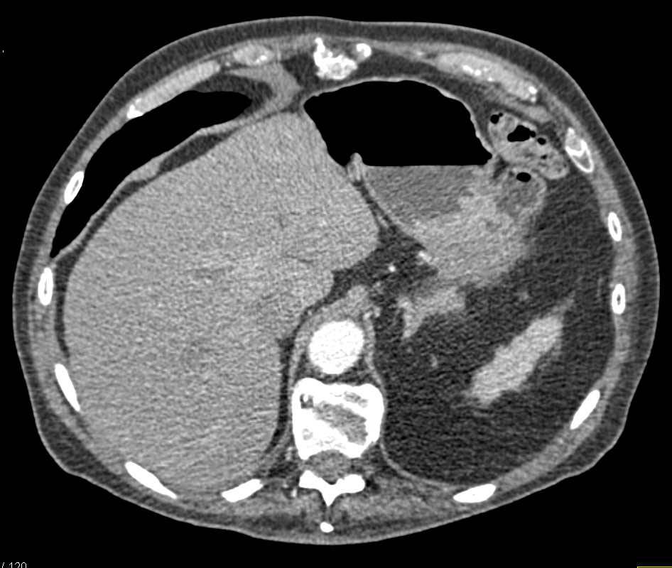 Gastric Adenocarcinoma - CTisus CT Scan