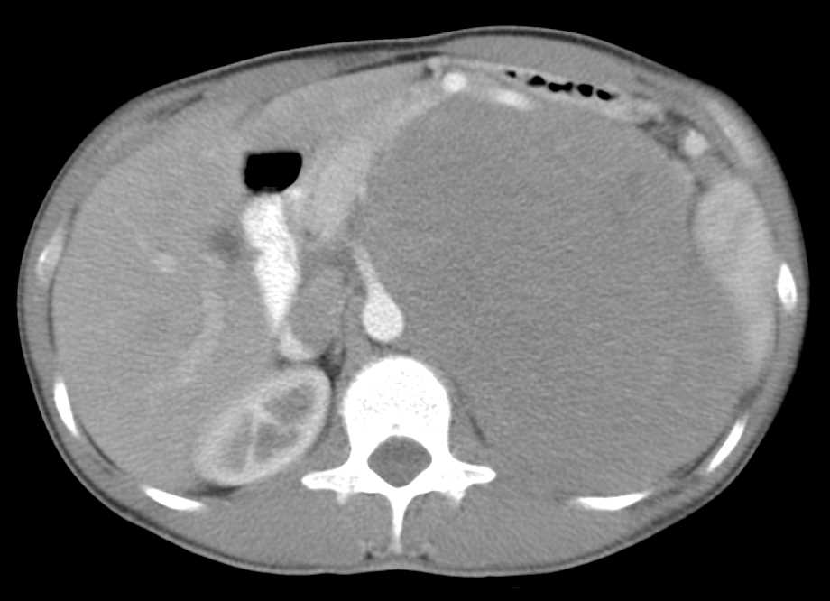 Gastric Exophytic GIST Tumor - CTisus CT Scan