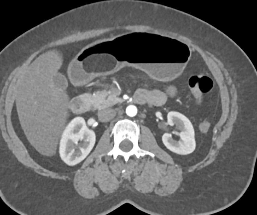 Gastric Lipoma - Stomach Case Studies - CTisus CT Scanning