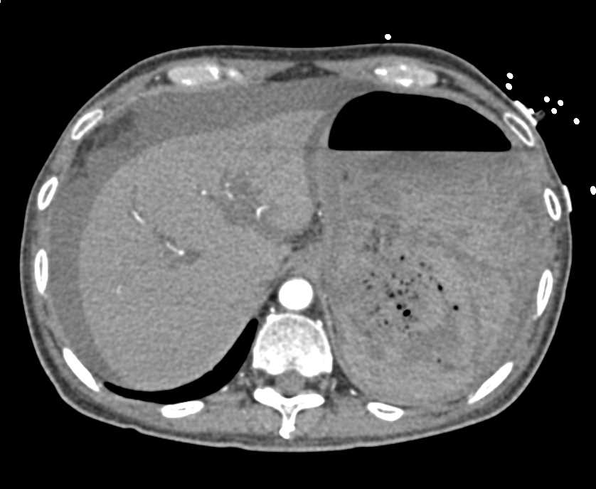 Active Gastric Bleed with a Large Intragastric Hematoma - CTisus CT Scan