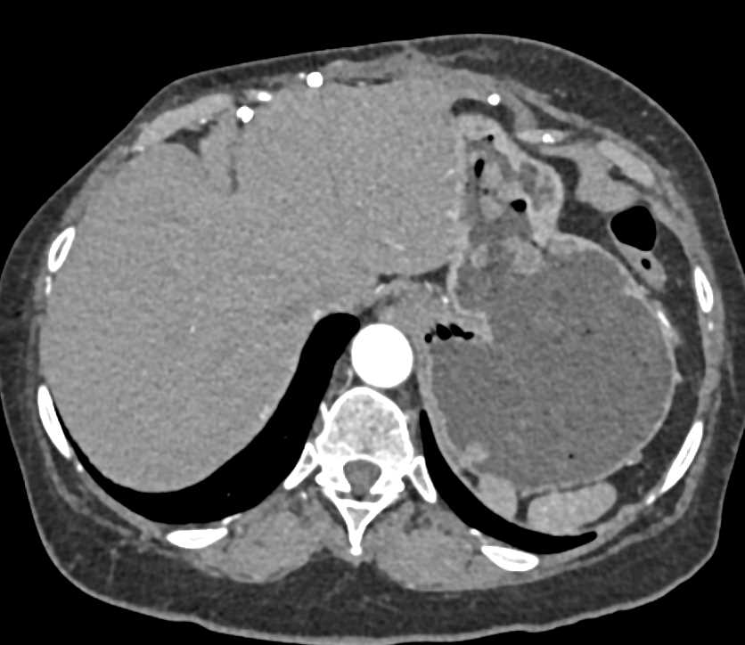 Multiple Gastric Polyps - CTisus CT Scan