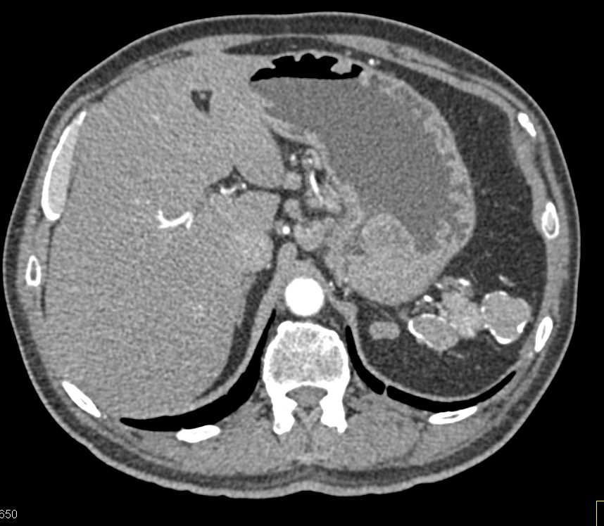 GIST Tumor Stomach - CTisus CT Scan