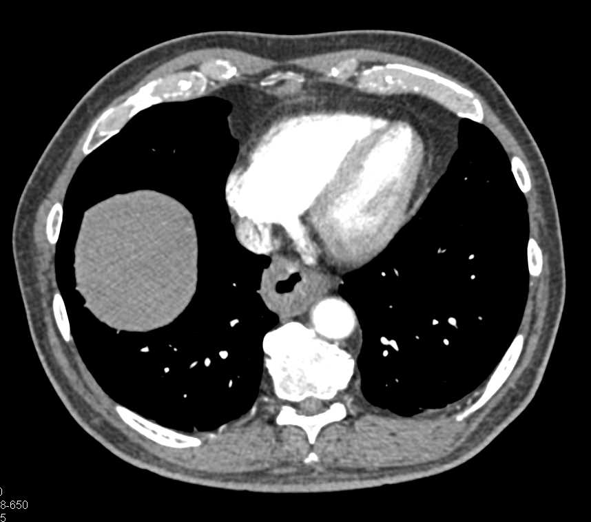 Multiple Gastric Polyps and GIST Tumor - CTisus CT Scan