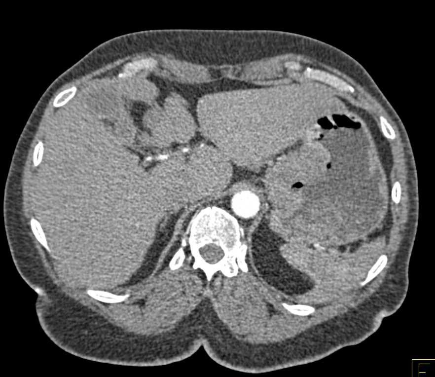 Gastric Adenocarcinoma in the Fundus of the Stomach - CTisus CT Scan