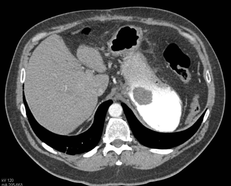 Gastric GIST Tumor - CTisus CT Scan