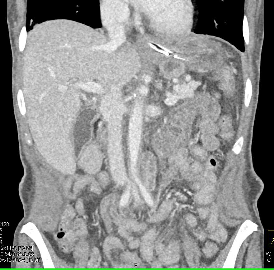 Bulky Gastric Adenocarcinoma With Extensive Adenopathy Stomach Case