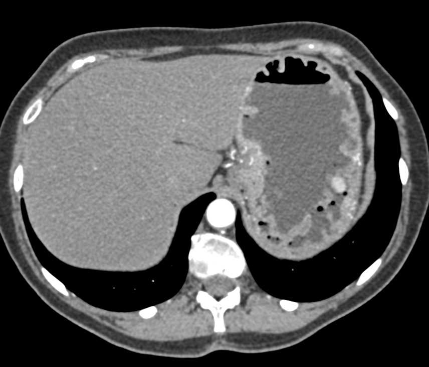 Zollinger Ellison Syndrome with Thickened Small Bowel Folds - CTisus CT Scan