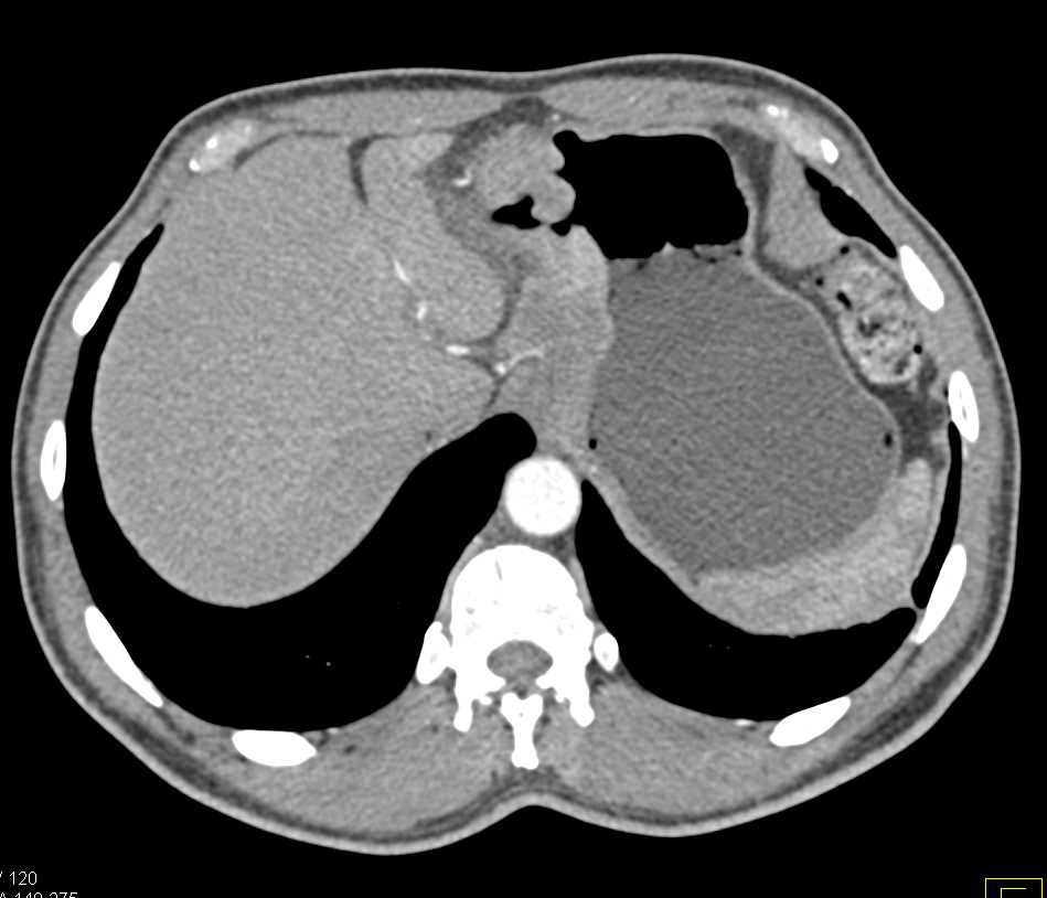 Infiltrating Adenocarcinoma of the Gastric Antrum - CTisus CT Scan