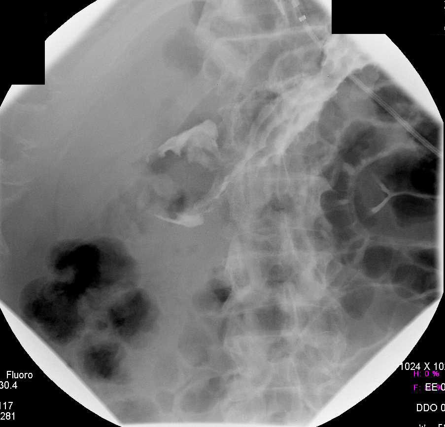 Gastric Cancer with Ulcer - CTisus CT Scan