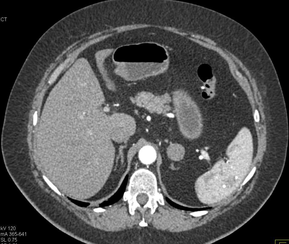 Gastric GIST Tumor Simulates an Adrenal Nodule - CTisus CT Scan