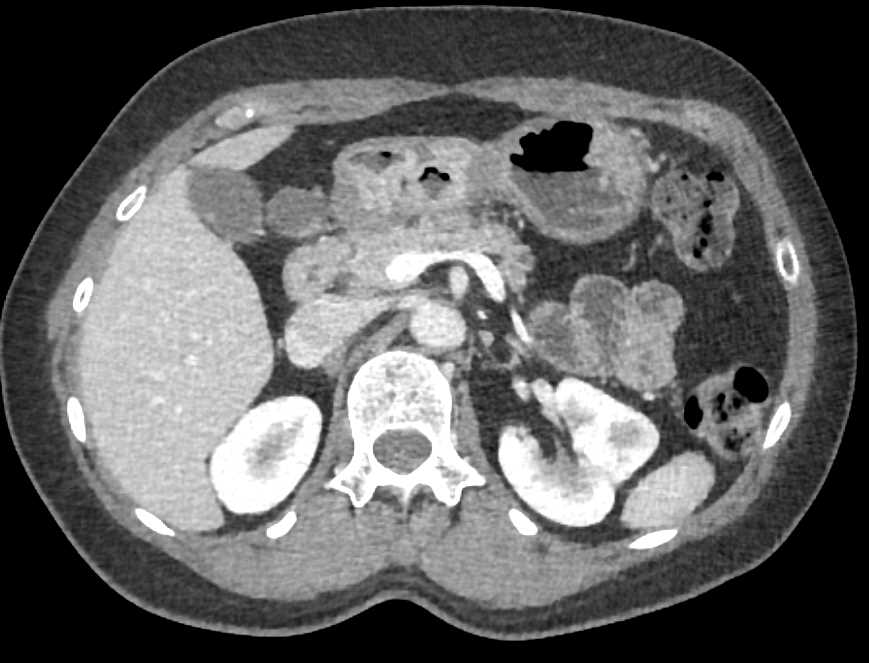 Gastric Adenocarcinoma - CTisus CT Scan