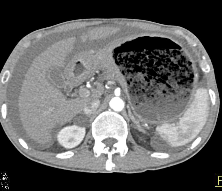 Infiltrating Gastric Adenocarcinoma with Carcinomatosis - CTisus CT Scan