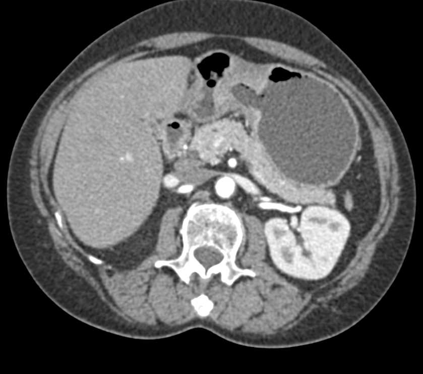 Gastric Antral Adenocarcinoma - CTisus CT Scan