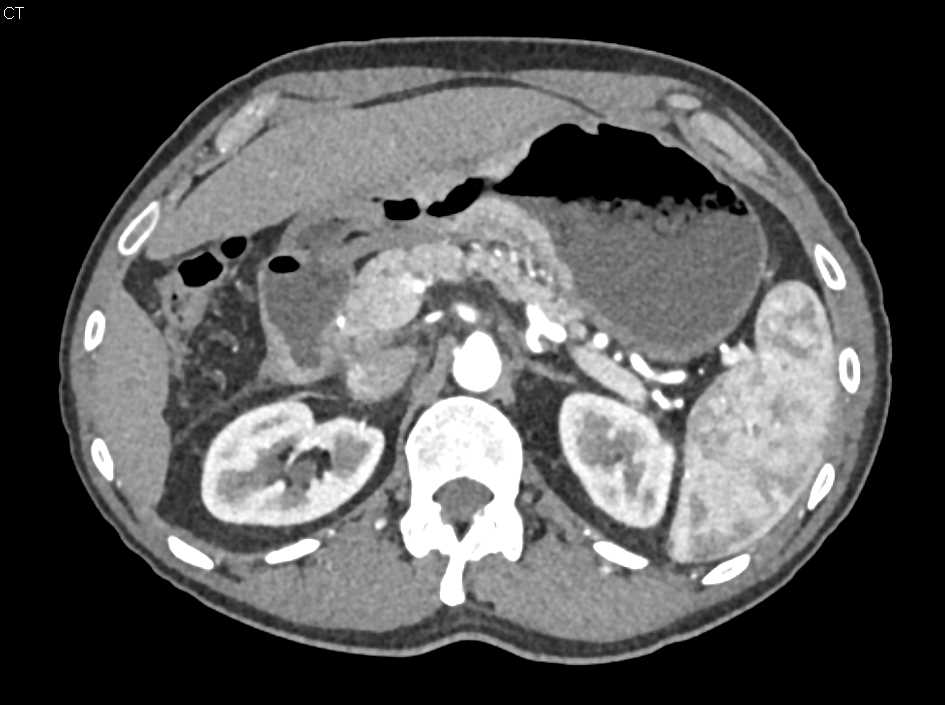 Antral Carcinoma with Infiltration - CTisus CT Scan