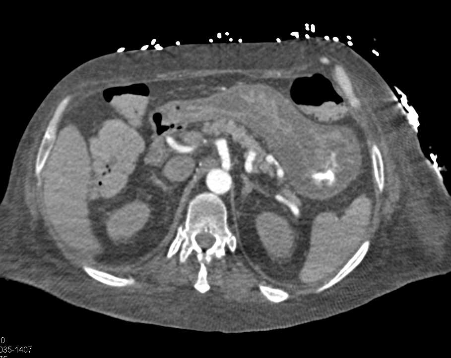 Severe Gastritis with Thickening of the Gastric Wall - CTisus CT Scan