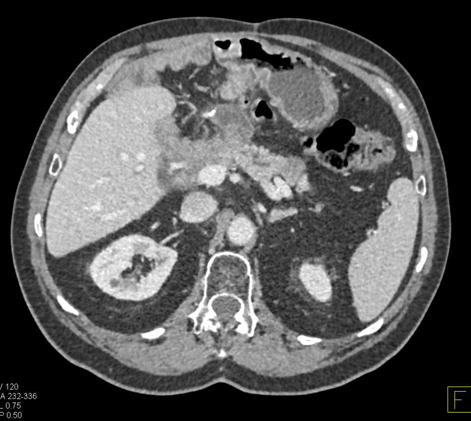 Recurrent Gastric Cancer - CTisus CT Scan