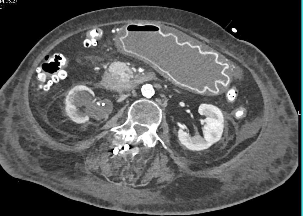 Abnormal Gastric Wall Enhancement - CTisus CT Scan