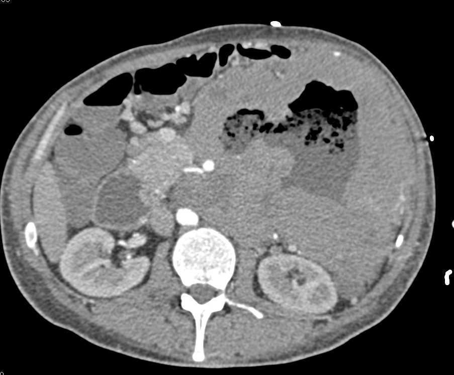 Ulcerating Gastric GIST Tumor - CTisus CT Scan