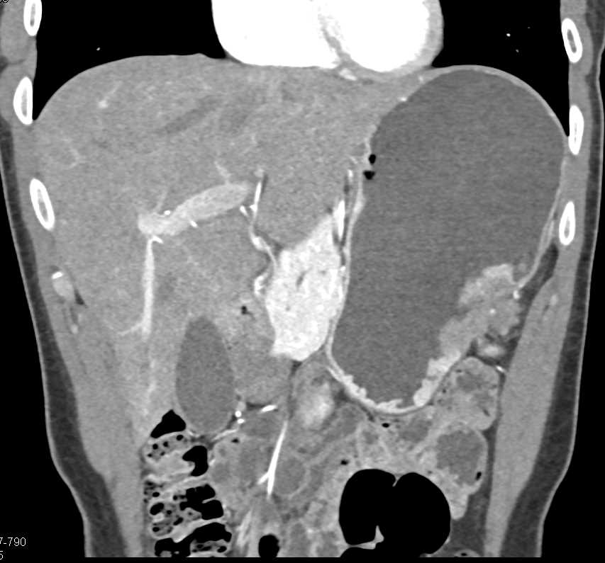 Gastric Cancer Along Greater Curvature of the Stomach - CTisus CT Scan