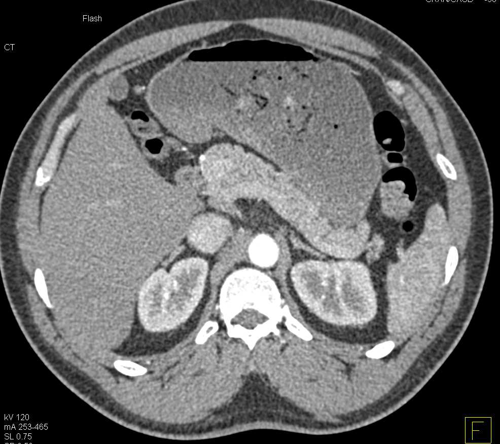 Retained Food in the Stomach - CTisus CT Scan