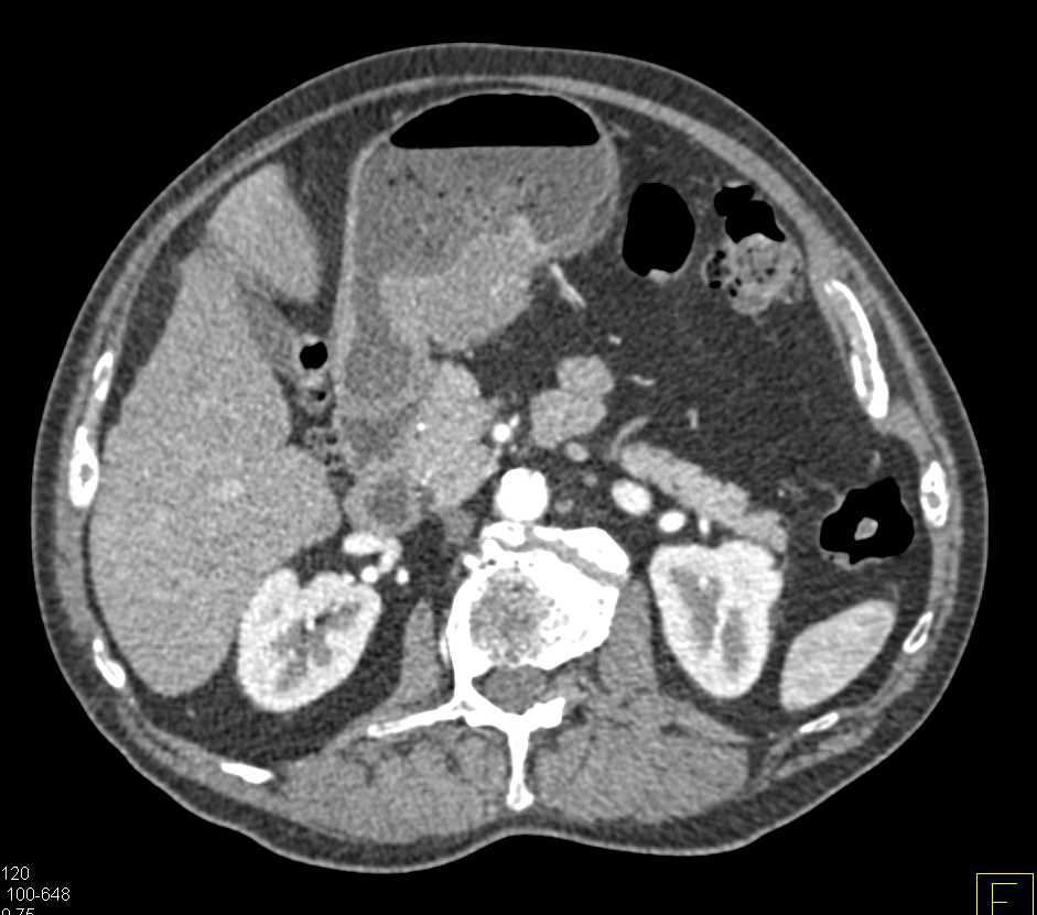 Gastric Cancer with Liver Metastases - CTisus CT Scan