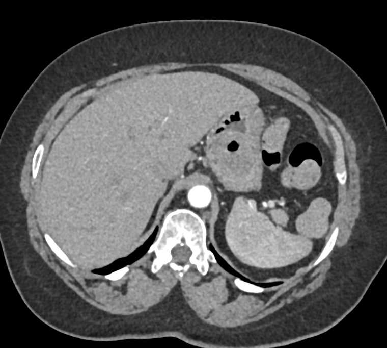 Ulcerating Gastric GIST Tumor - CTisus CT Scan