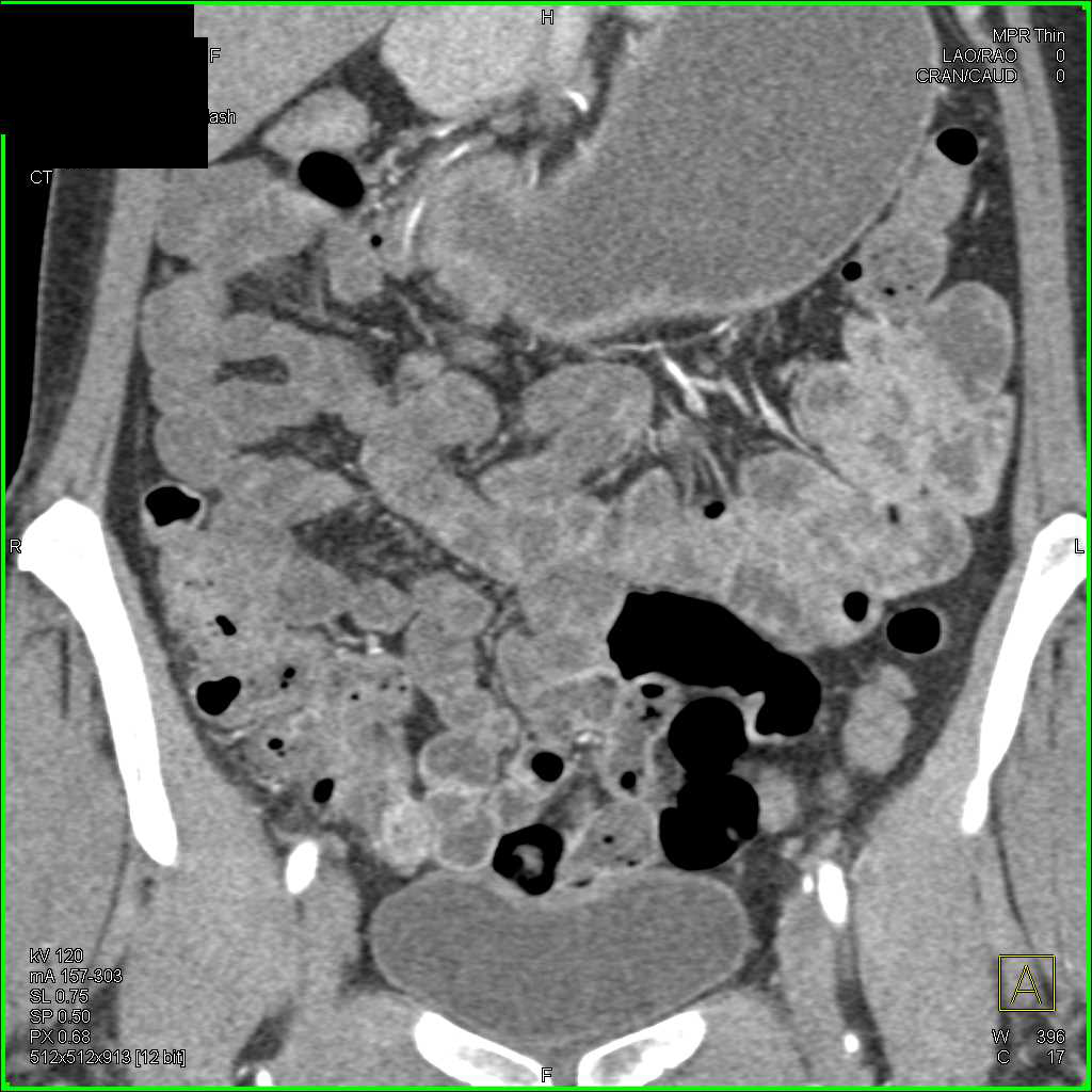 Carcinoma of the Gastric Antrum - CTisus CT Scan