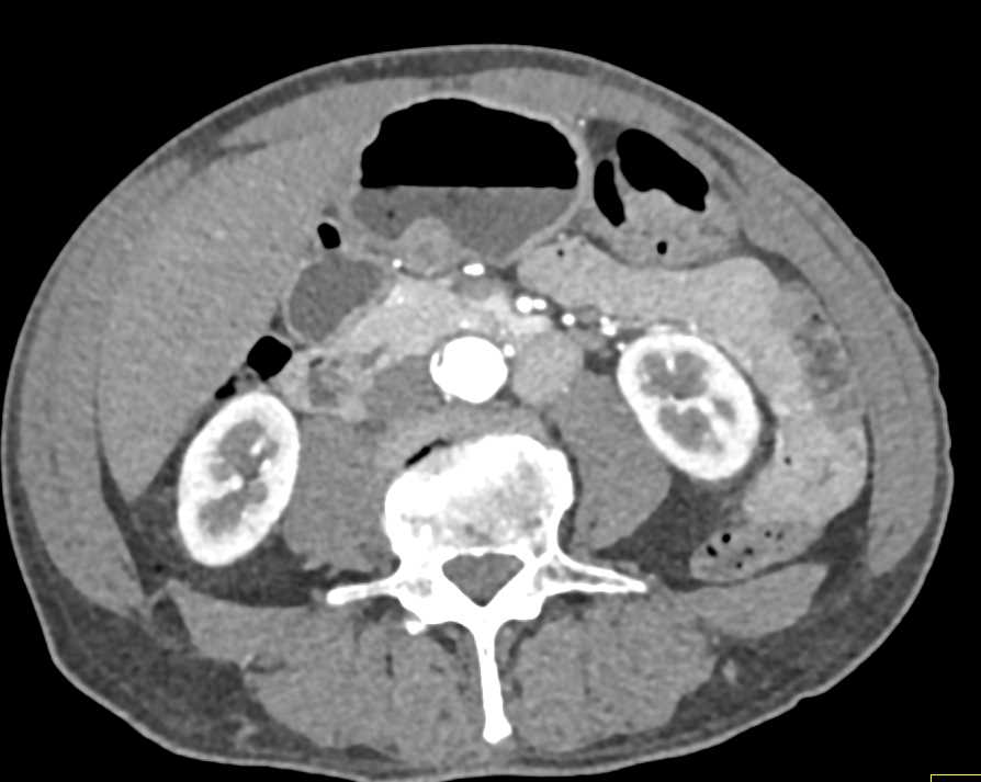 Gastric Leiomyoma - CTisus CT Scan